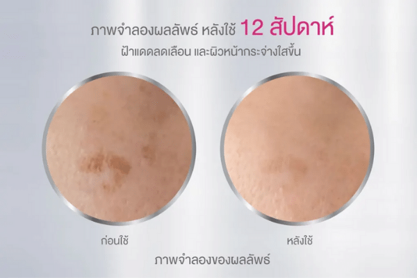 nivea luminous 630 spotclear treatment ผลลัพธ์หลัง 12 สัปดาห์.png